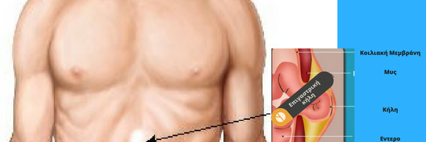 επιγαστρική κήλη